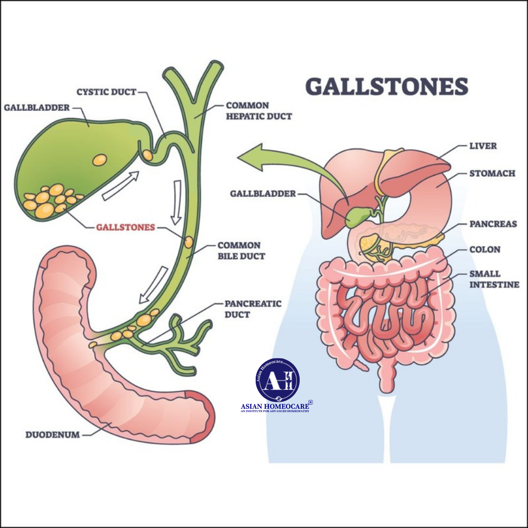 Gallstones Symptoms Causes and Homeopathy medicine for Gall stones Asian Homeocare Homeoapthy clinics and Doctors