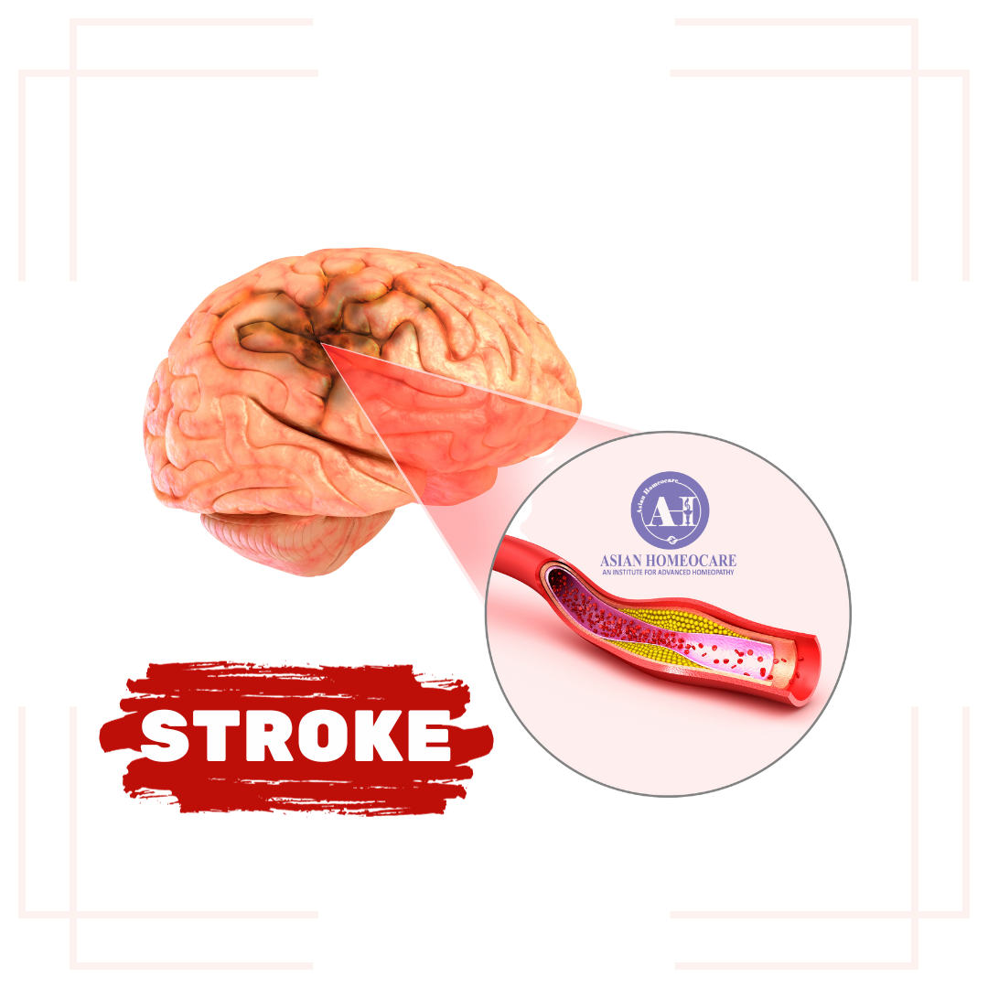 Stroke: Causes, Symptoms, and Homeopathic medicines | Asian 