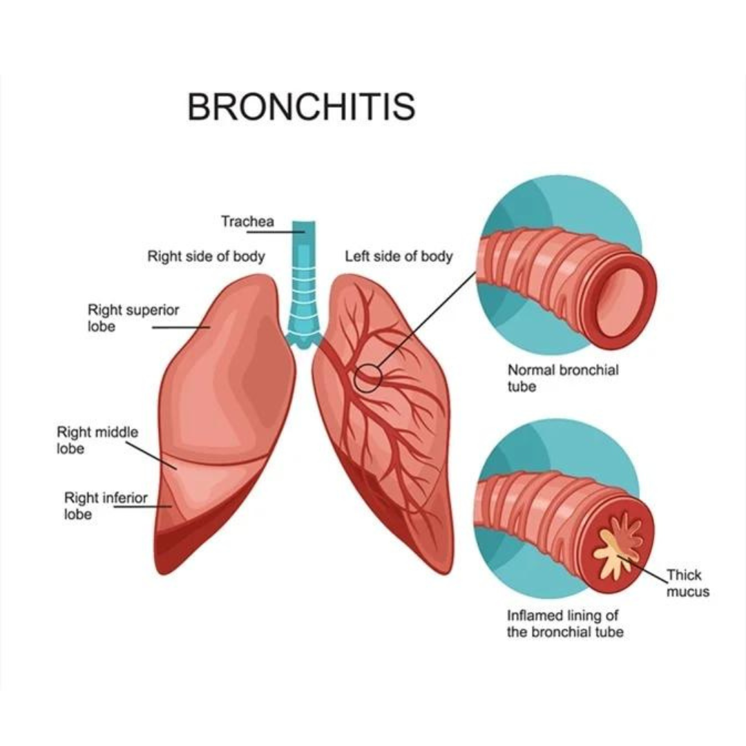 Bronchitis