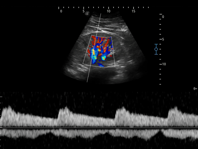 doppler renal en los olivos