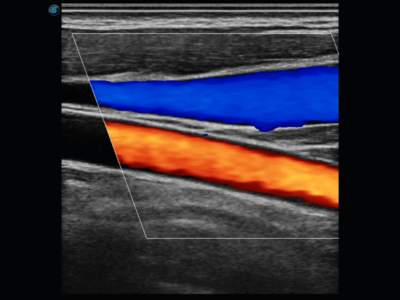 ecografia doppler en los olivos