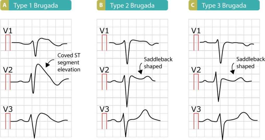 Brugada