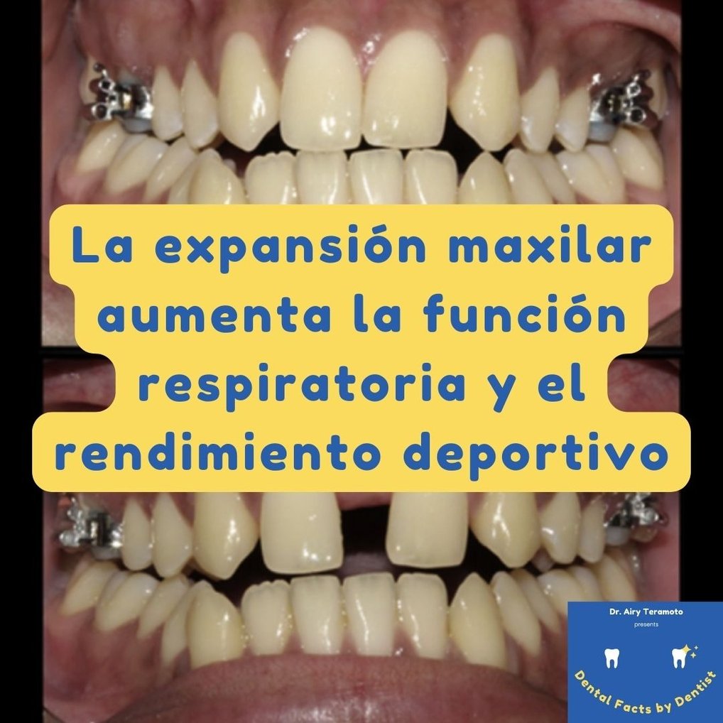 expansion maixlar