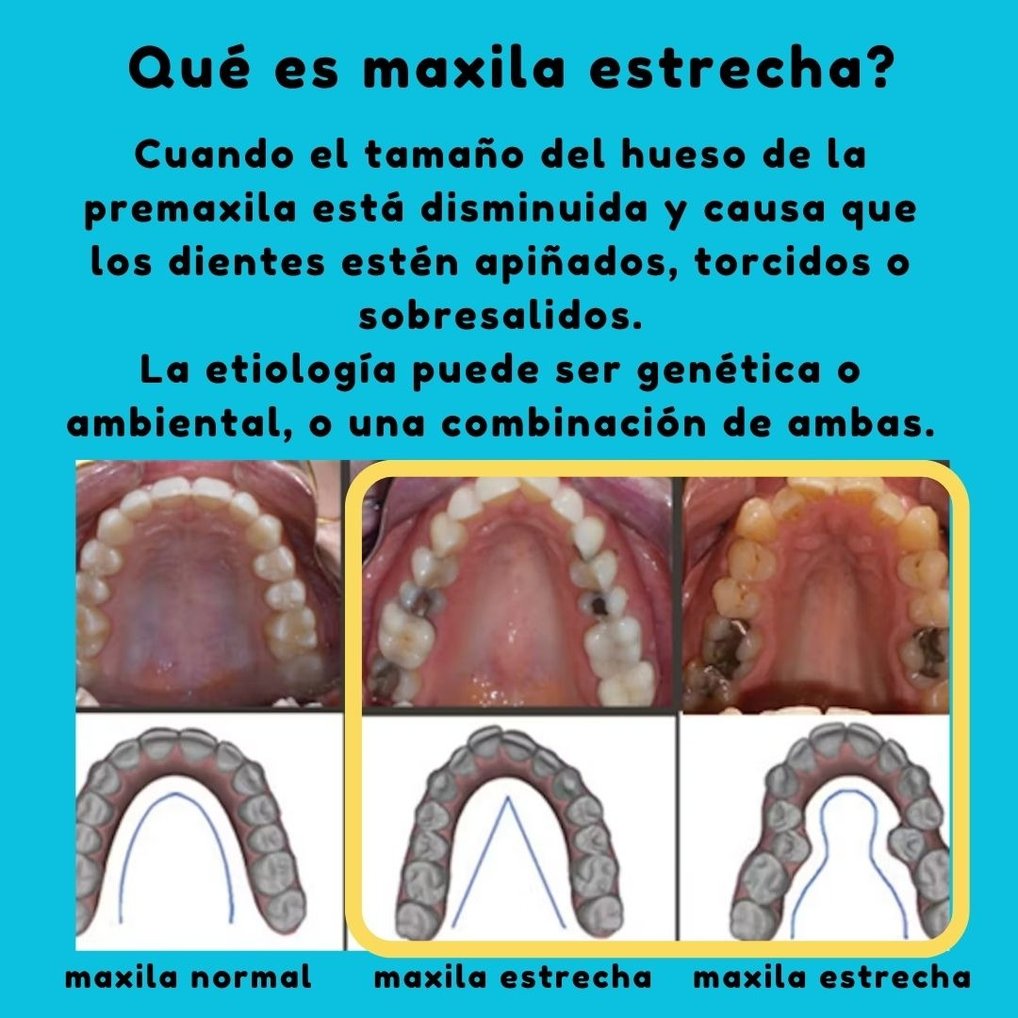 expansion maixlar