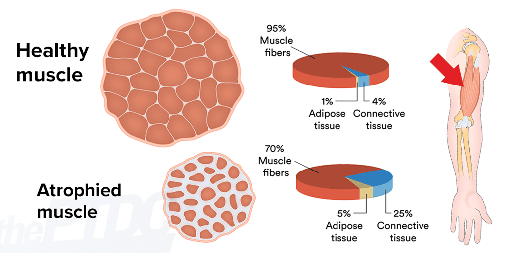 muscle atrophy