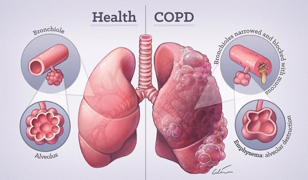 COPD