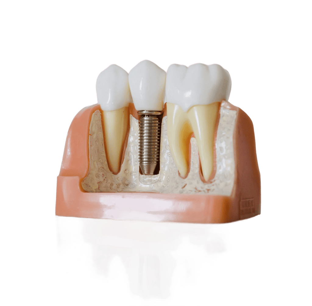 Modelo dental en corte transversal que muestra un tornillo de implante dental titanio entre dientes