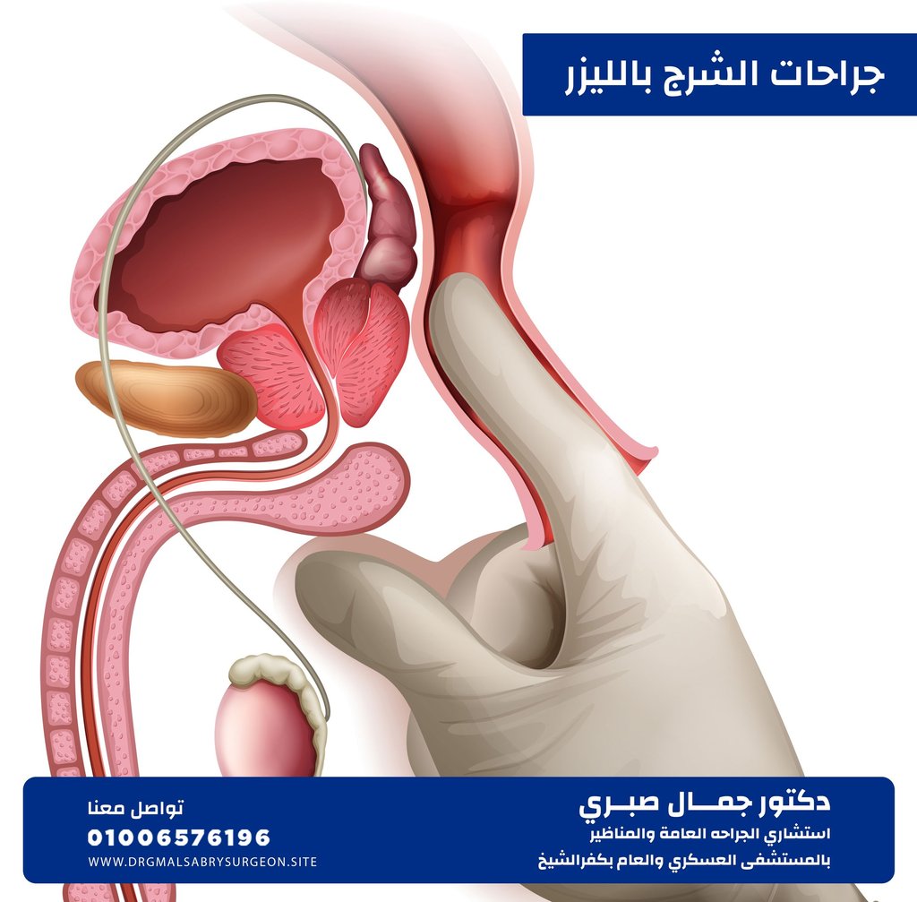 جراحــات الشرج كفرالشيخ