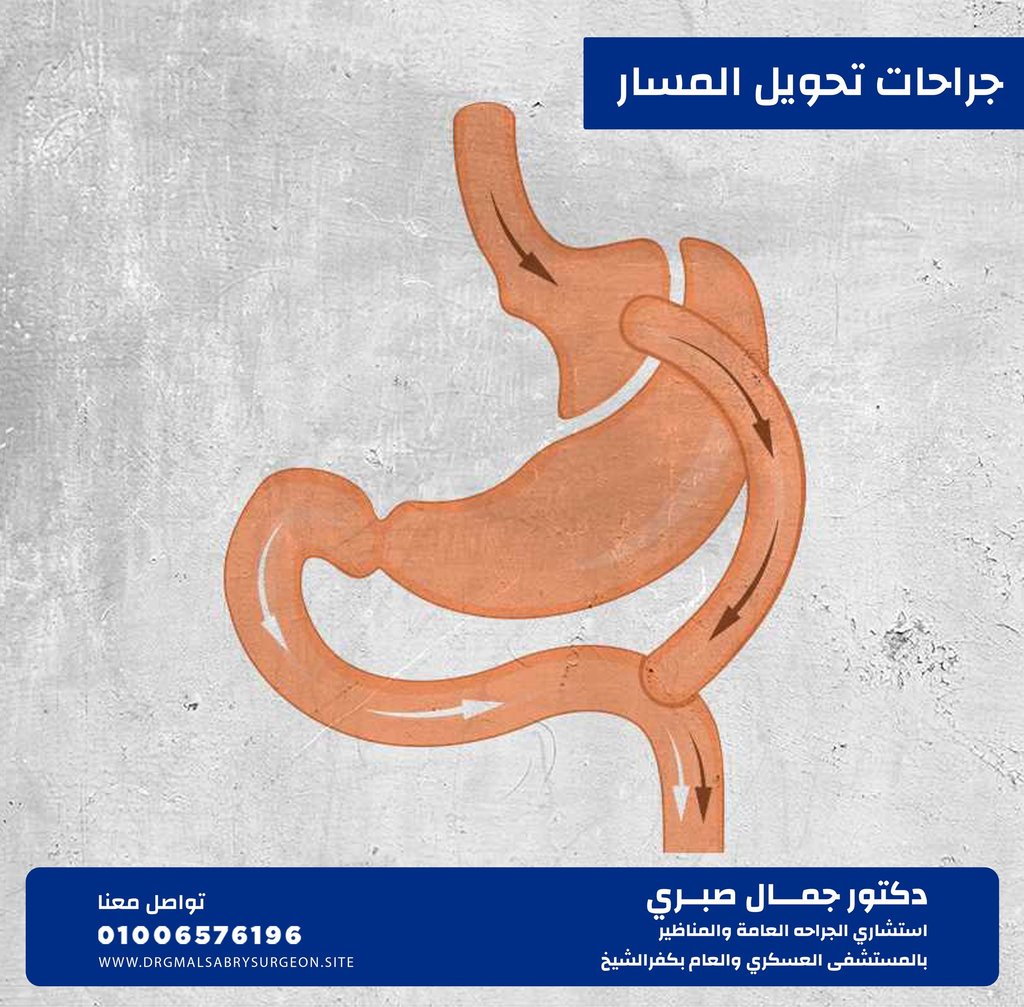 جراحات تحويل المسار كفرالشيخ