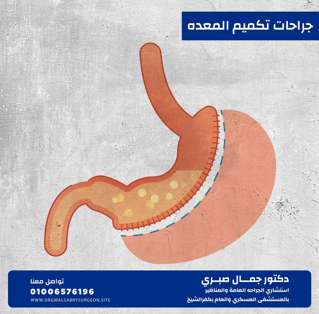 جراحات تكميم المعده كفرالشيخ