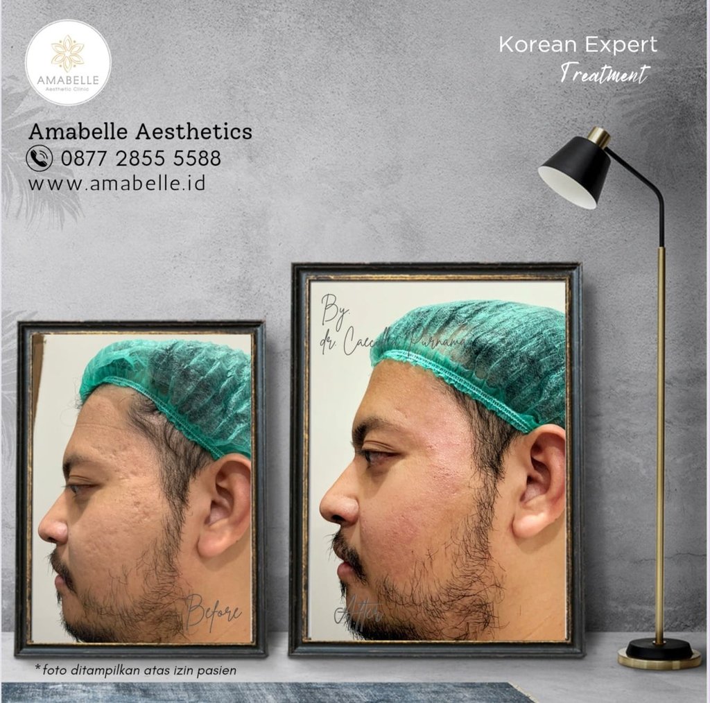 amabelle before after korean expert treatment