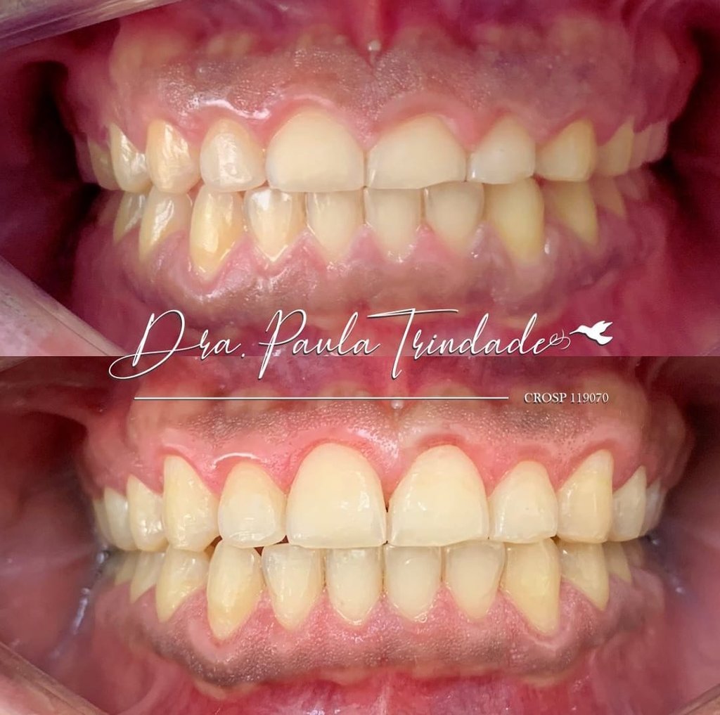 Dra Paula Trindade Cirurgia de Gengivoplastia: tratamento odontológico estético e funcional Campinas