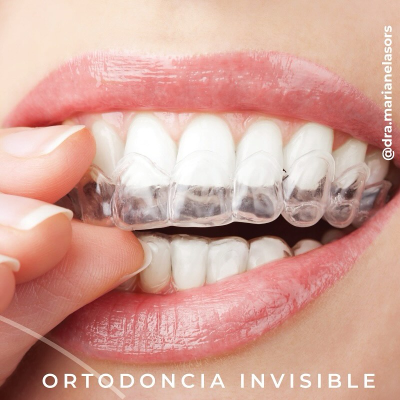 Alineadores invisibles para ortodoncia estética.  Ortodoncia invisible Dra Sors