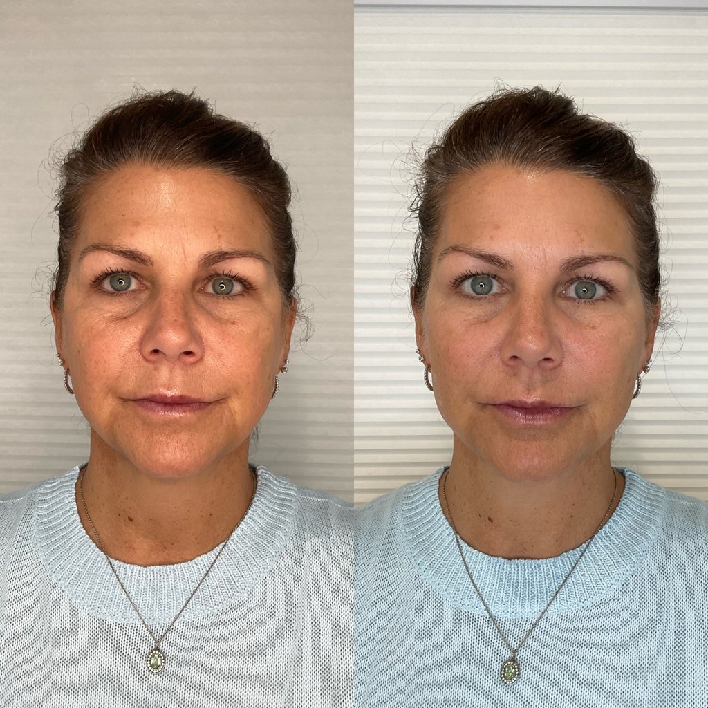 dermal filler and sculptra 