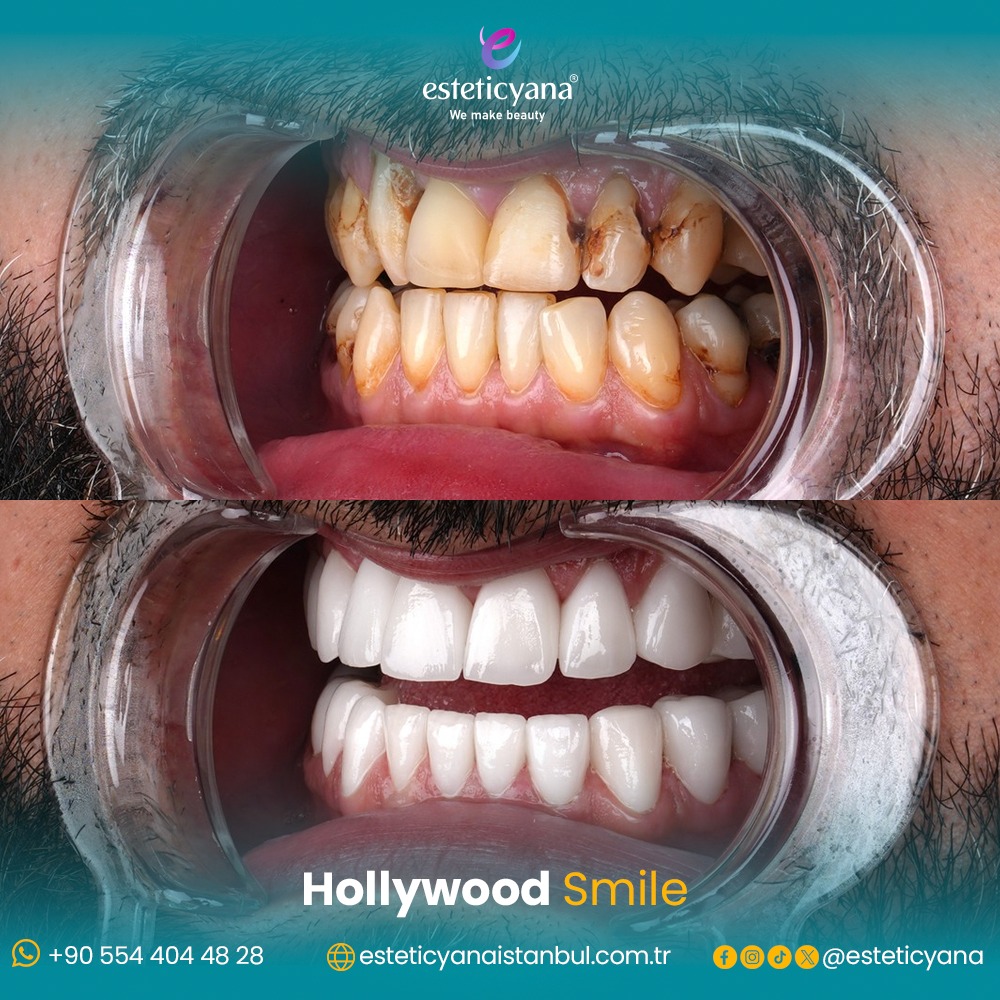 Hollywood smile before and after