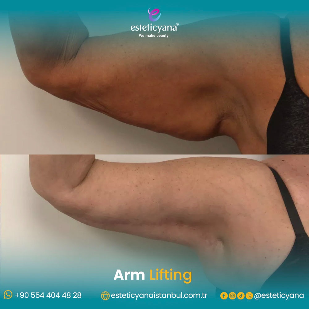 Arm lift before and after