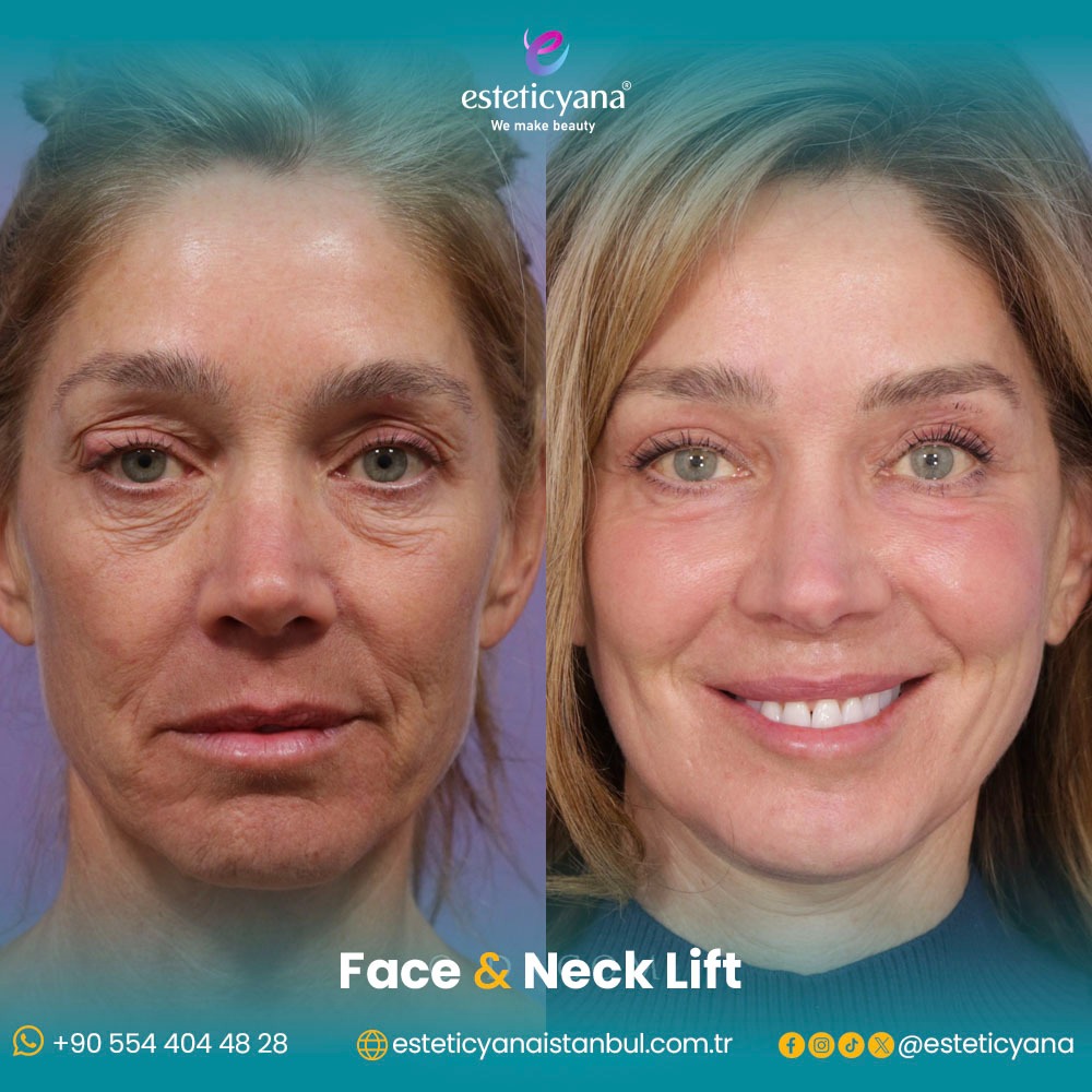 Face and neck lift before and after