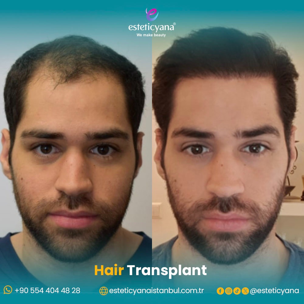 hair transplant before and after