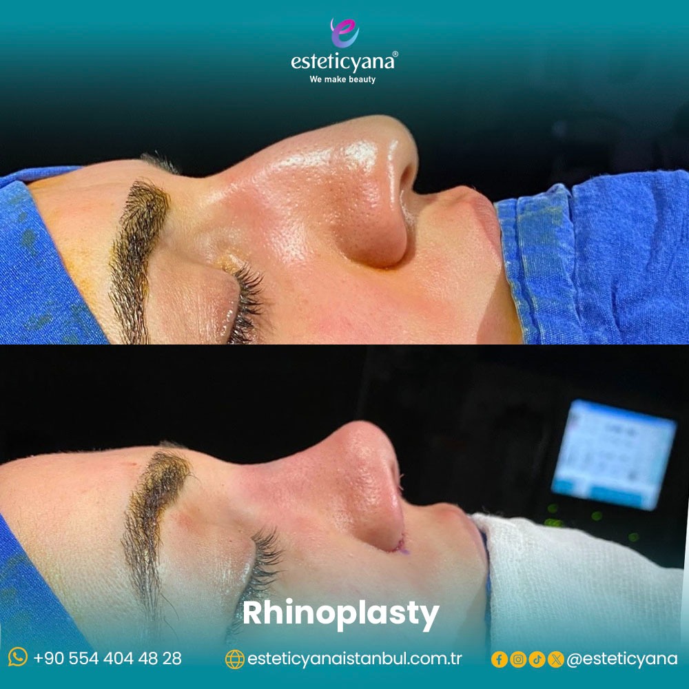 Rhinoplasty before and after