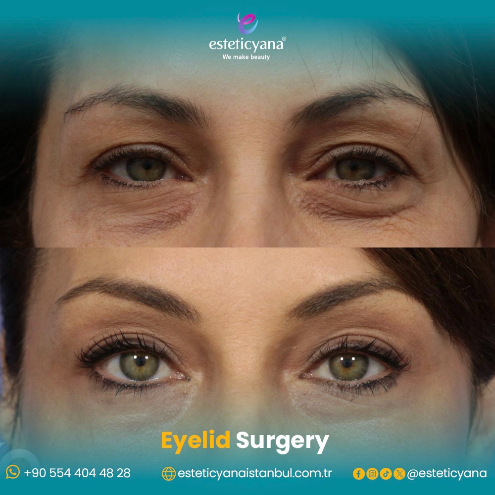 blepharoplasty before and after