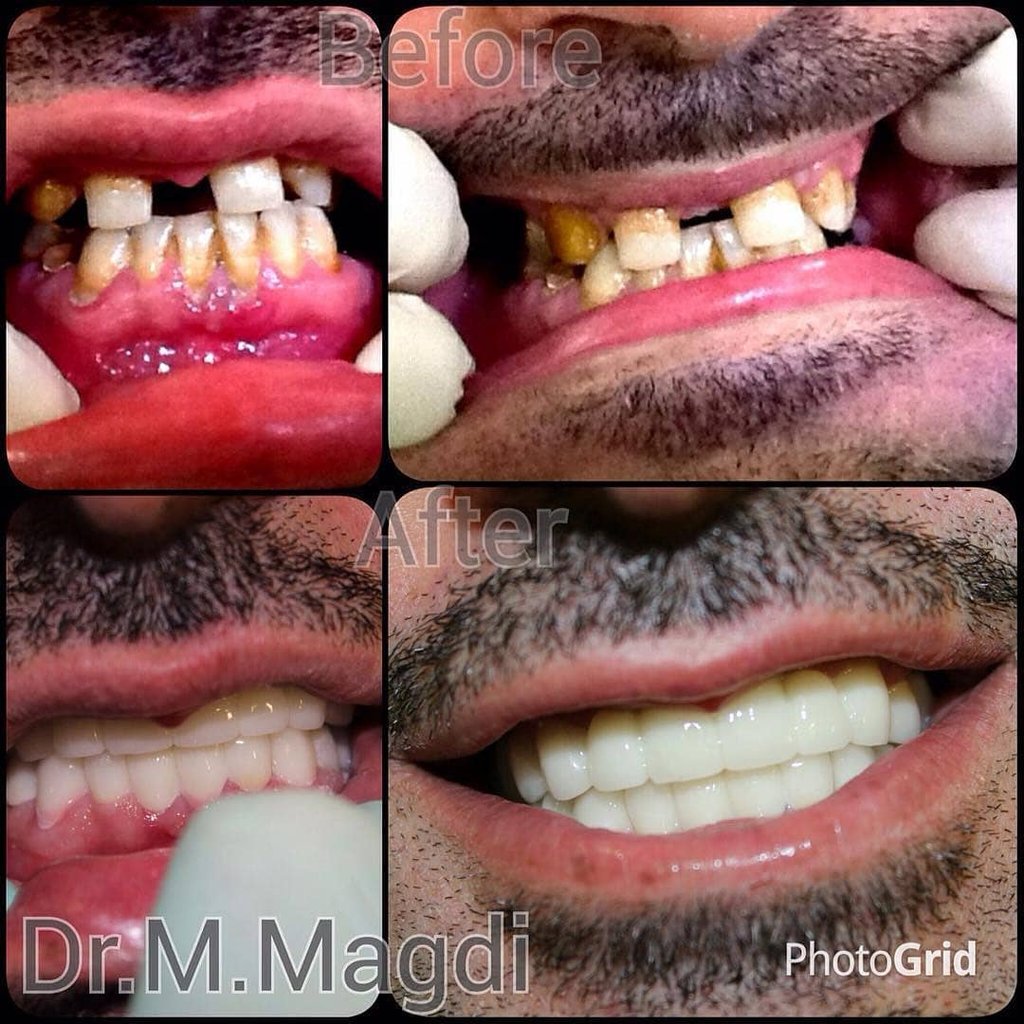 تقويم اسنان الكويت