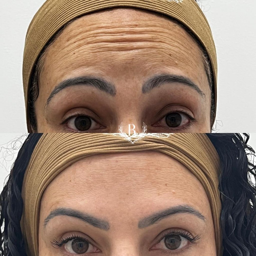 aplicação de toxina botulínica no rosto - clínica Tatuapé