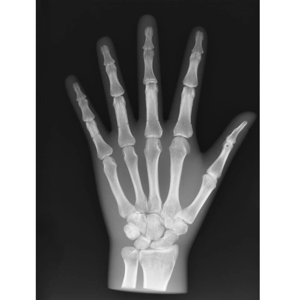 Hand Xray