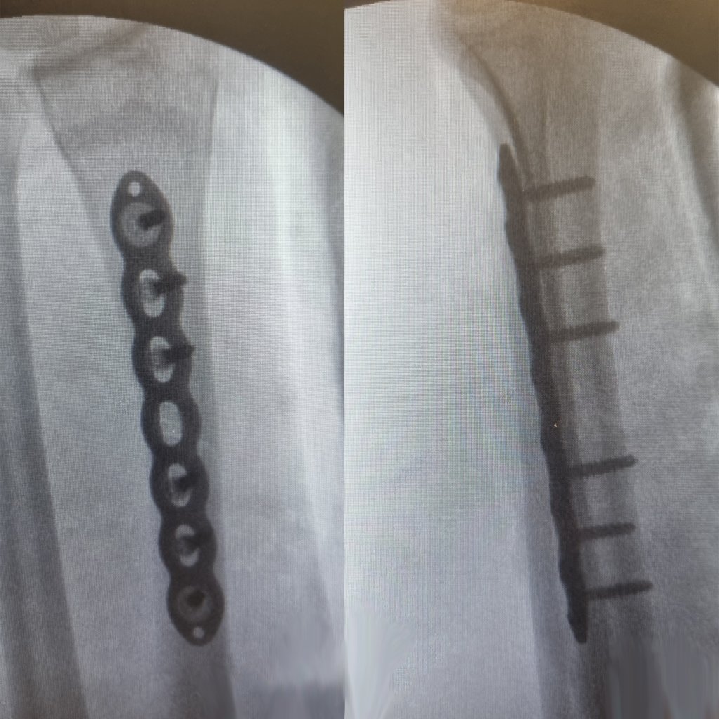 Mike MTB INJURY Broken Arm Plates Twisted Oaks 04-05-2024