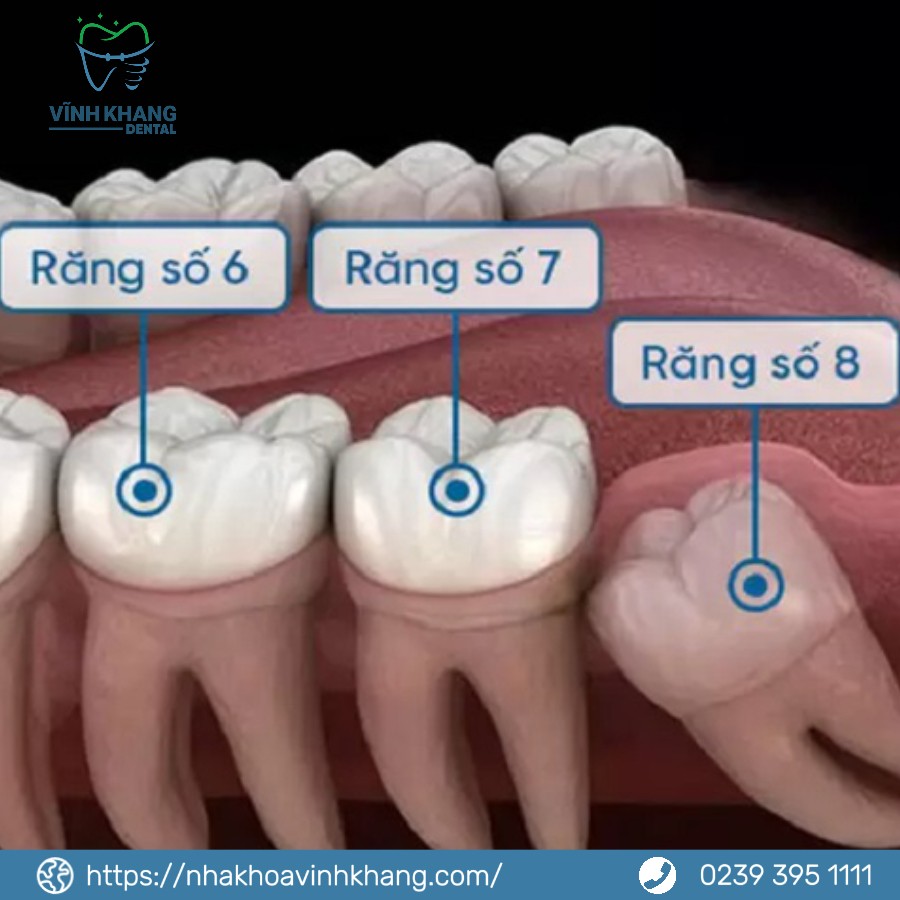 Những Lý Do Chính Để Nhổ Răng Khôn