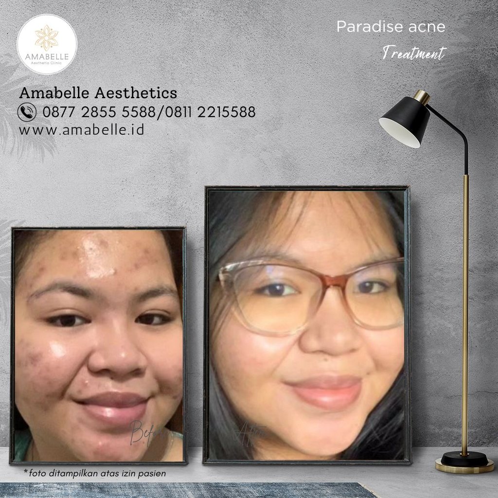 amabelle before after anti acne treatment