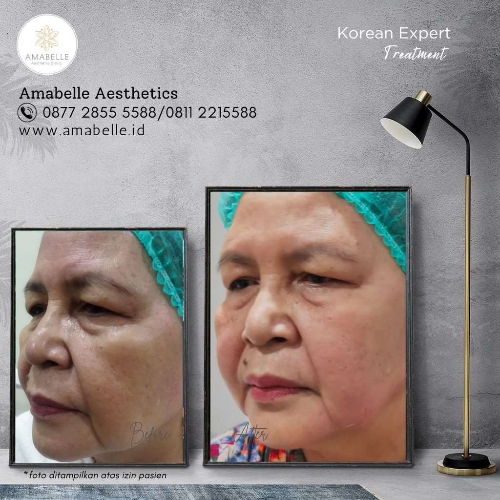 amabelle before after korean expert treatment
