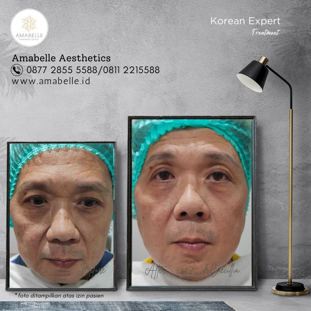 amabelle before after korean expert treatment