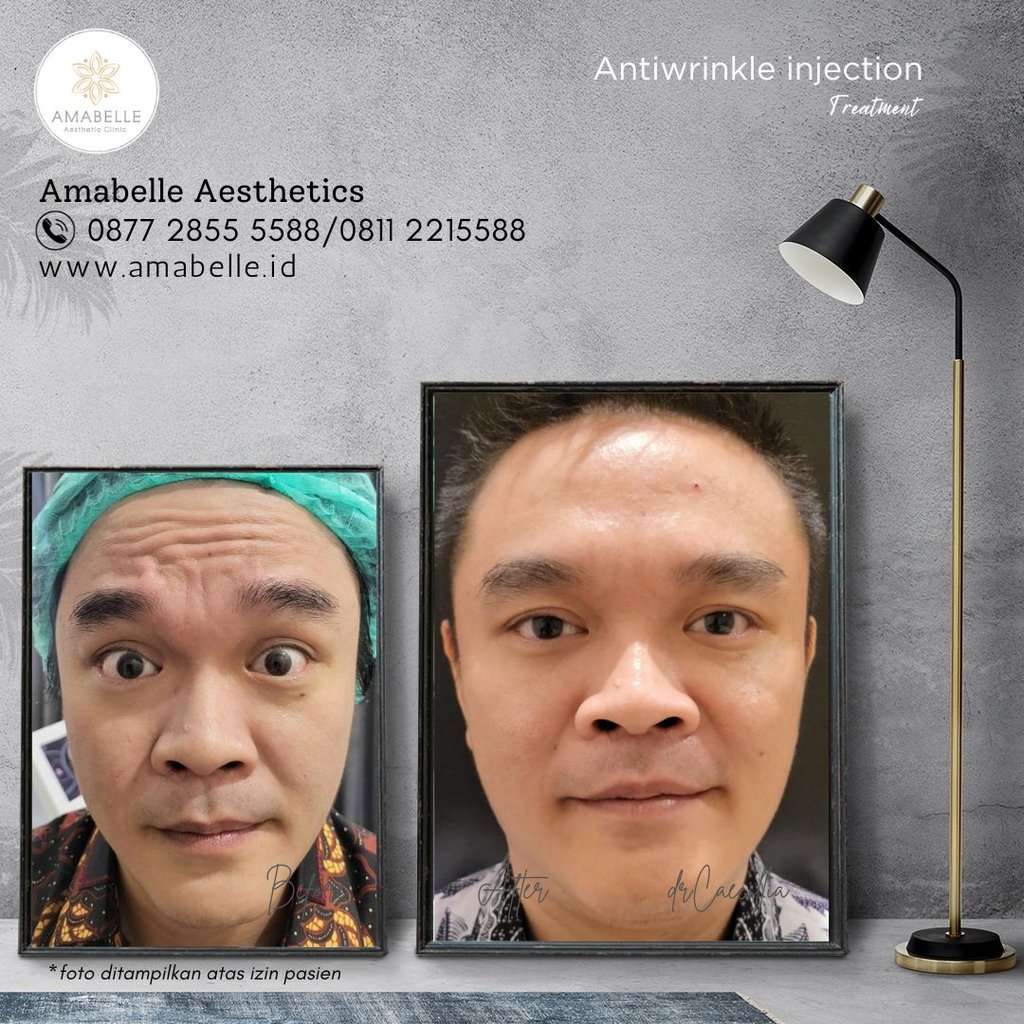 amabelle before after anti wrinkle treatment