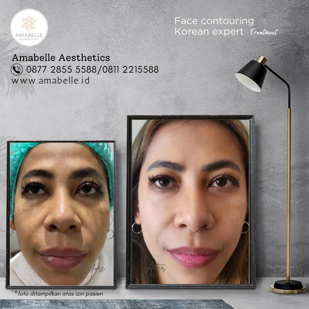 amabelle before after face contouring treatment