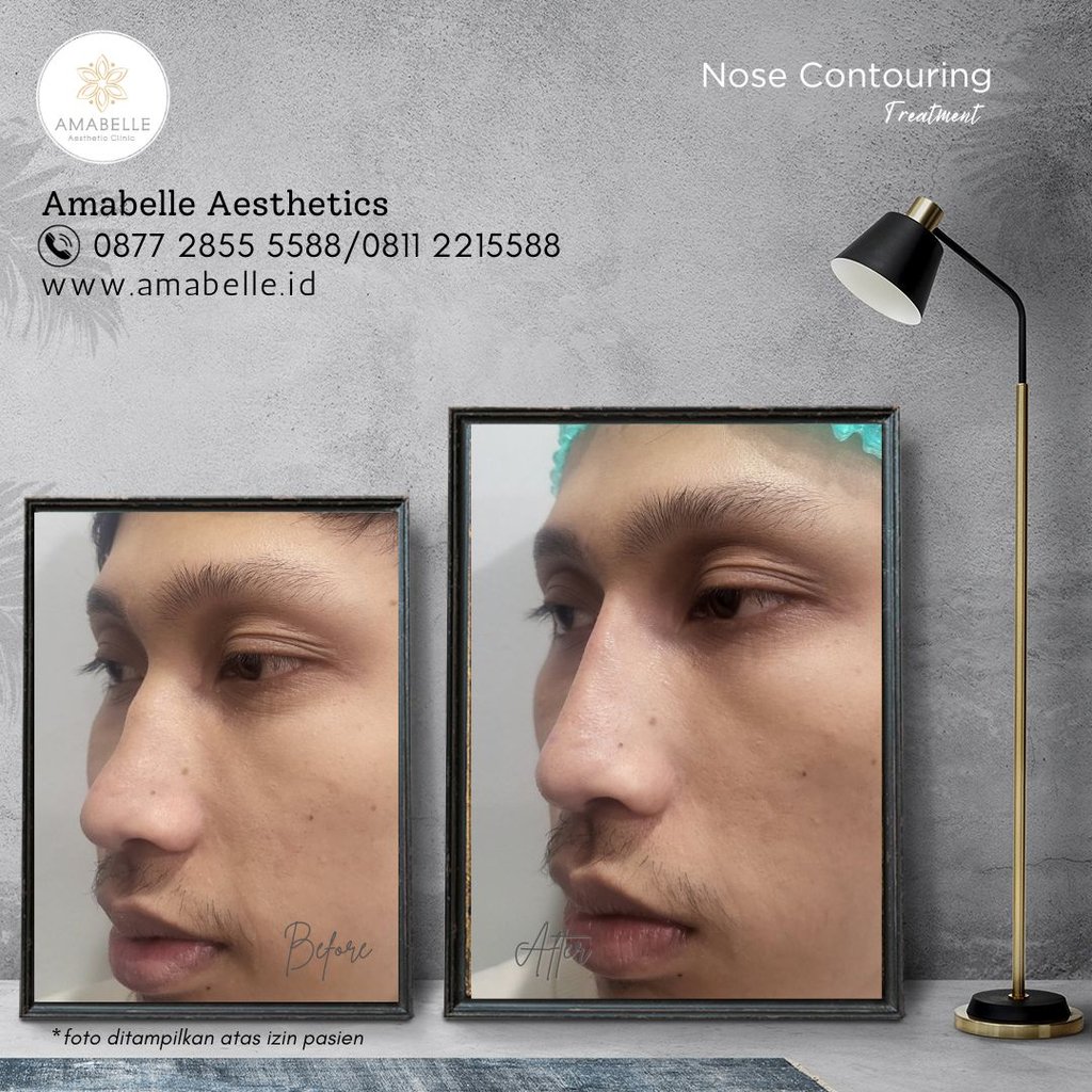 amabelle before after face contouring treatment