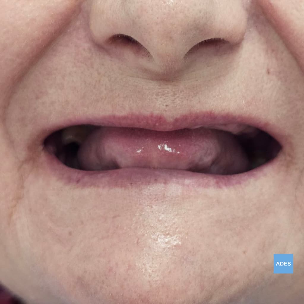 Paciente recibiendo implantes dentales en Badajoz