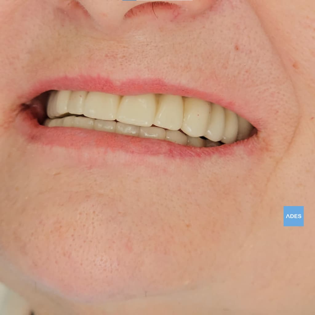 Sonrisa después de implantes en Badajoz