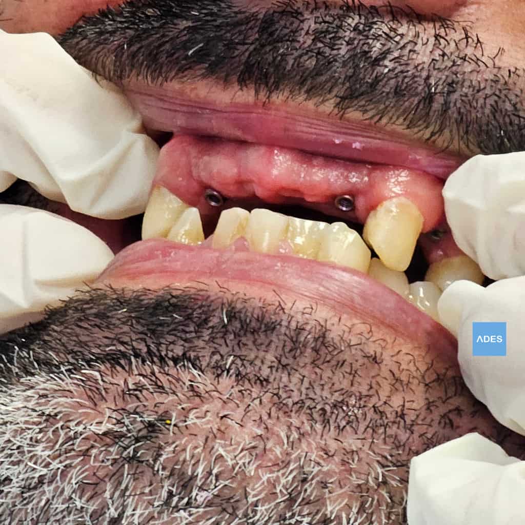 colocación implantes