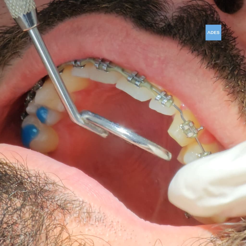 Tratamiento dental para adultos en Badajoz