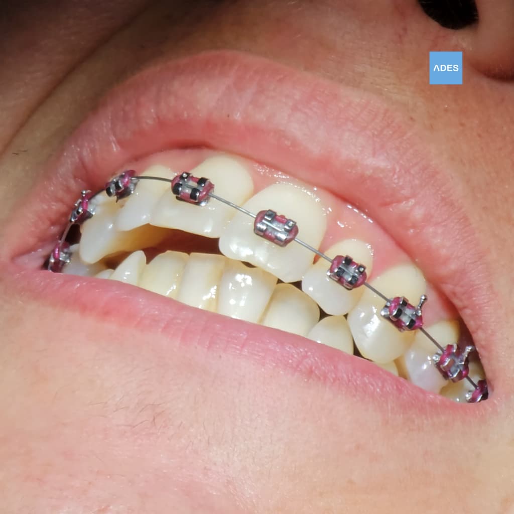 Revisión de ortodoncia en Clínica Dental ADES
