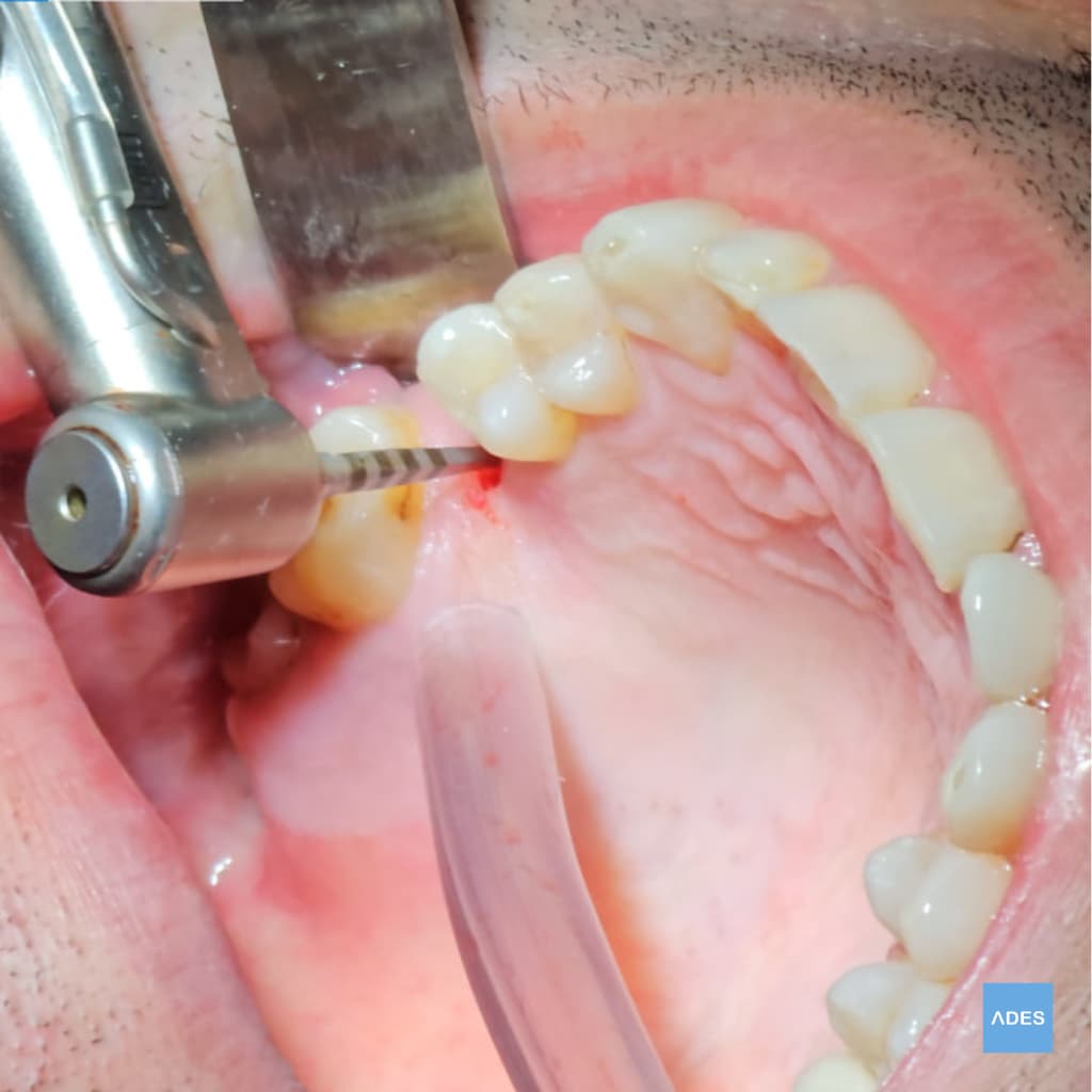 Implantología dental en Badajoz