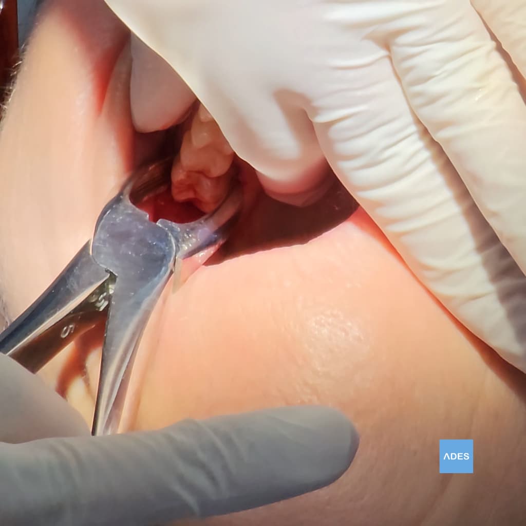 extracción muela juicio