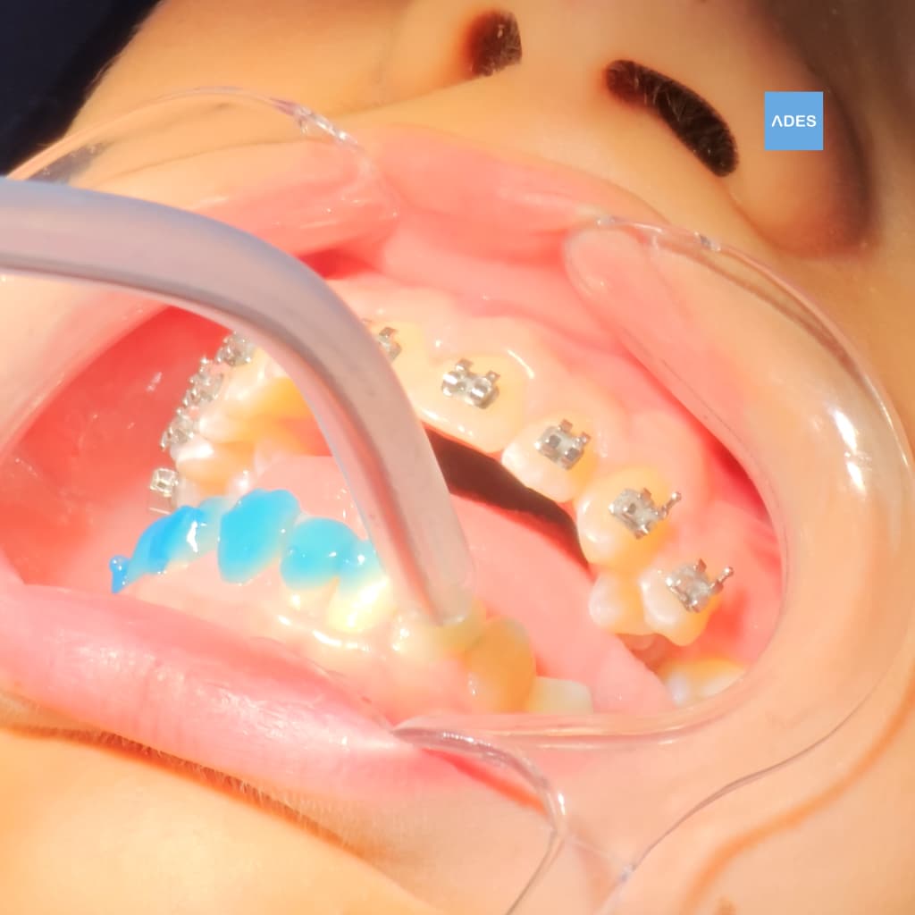 cementado brackets clinica dental ades