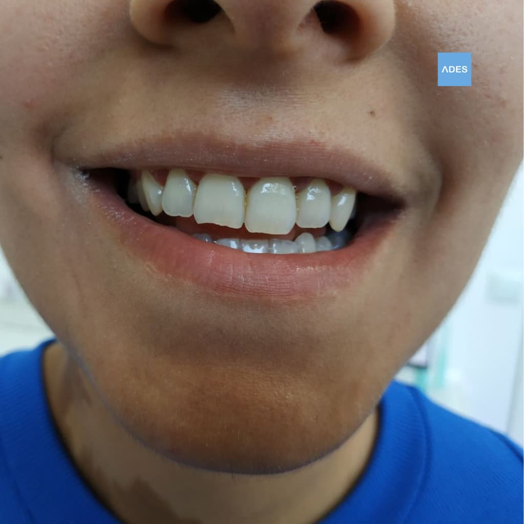 clinica dental ades ortodoncia infantil