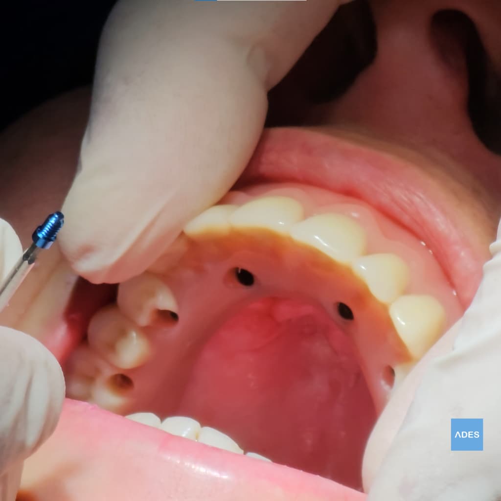 protesis sobre implantes