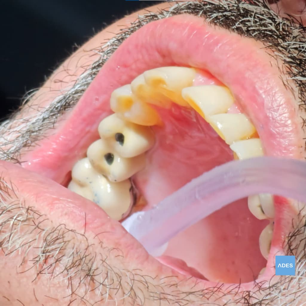 puente sobre implantes