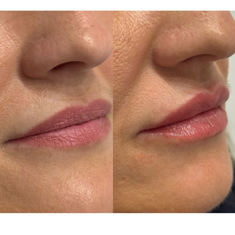 powiększanie ust Pruszków