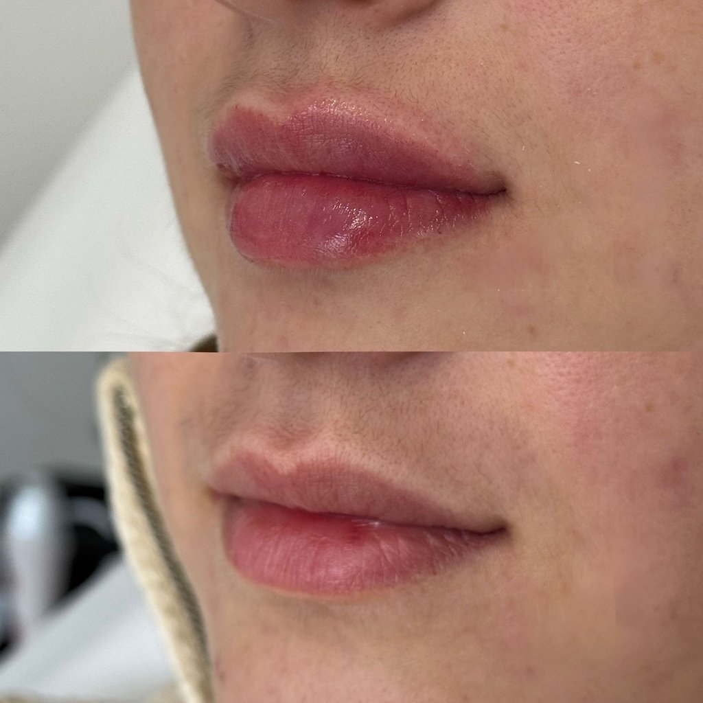 powiększanie ust Pruszków