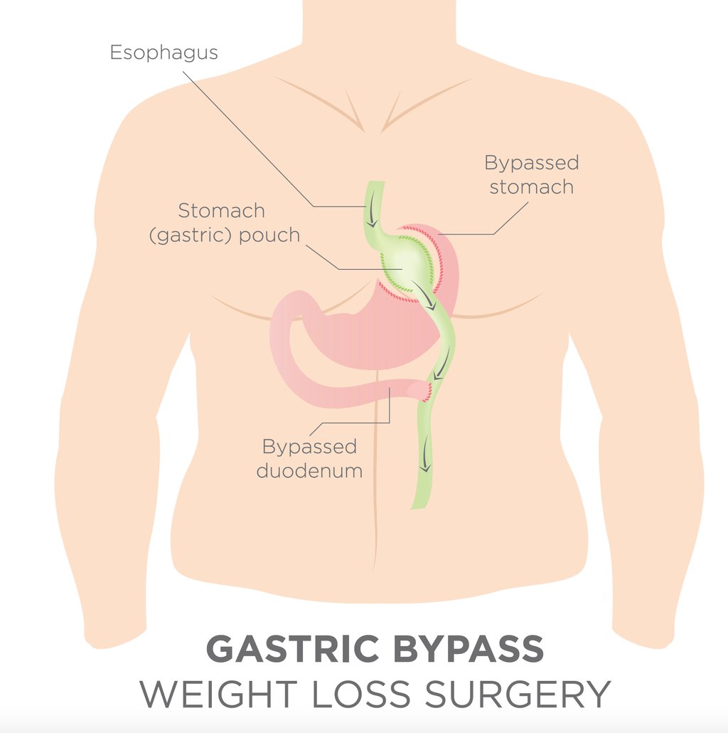Gyomor bypass, Roux-en-Y gastric bypass