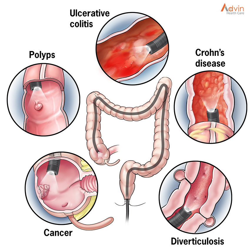 a colon with reasons of why colonoscopy is done